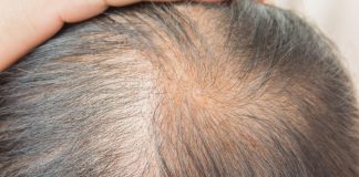 Find the Best Hair Regrowth Treatment to Get Back Hair on Your Head